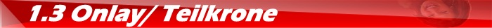1.3 Onlay/ Teilkrone